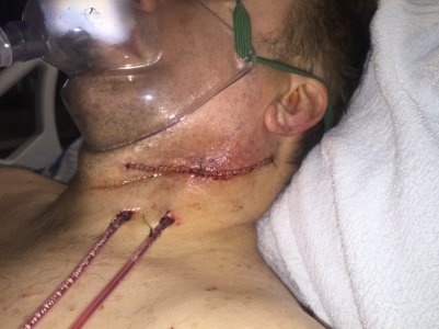 Big Incision.jpg Big Incision.jpg